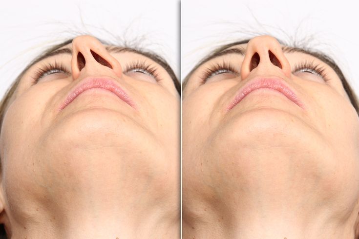 lệch vách ngăn mũi gây khó thở
