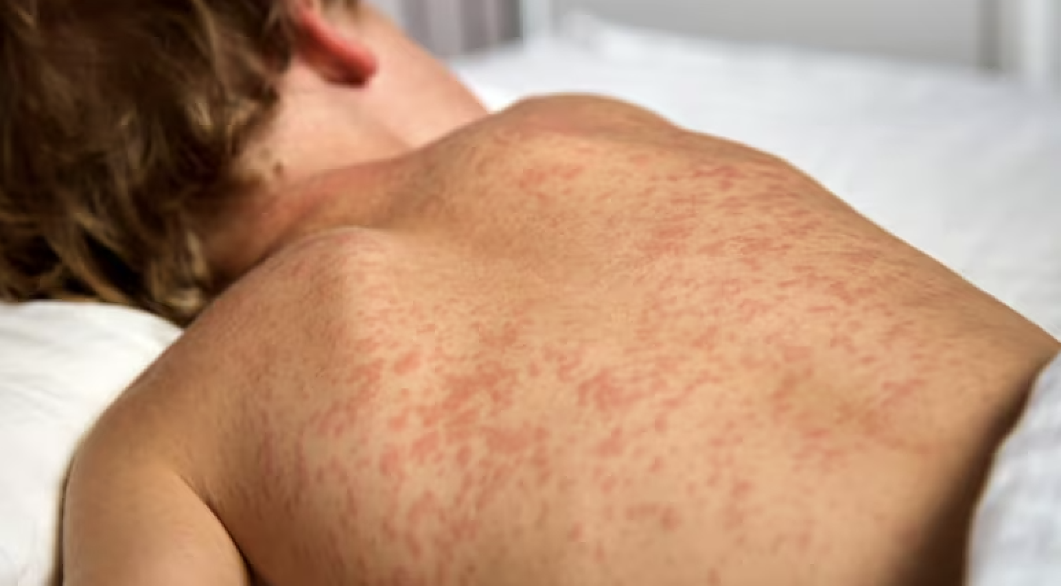 bệnh sởi không nên xem thường