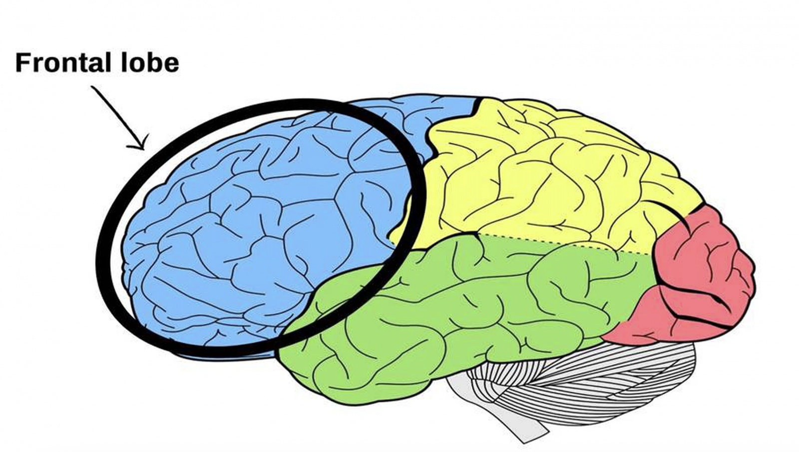 Tổn thương thuỳ trán có thể gây ADHD