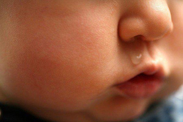 Đường mũi của trẻ nhỏ hẹp nên dễ bị nghẹt khi niêm mạc sưng nề