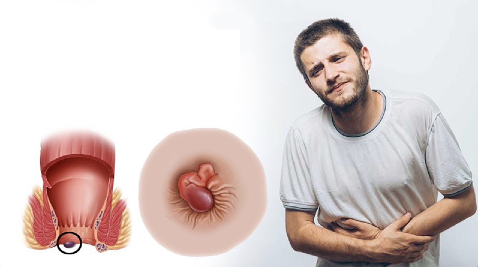 Táo bón kéo dài làm tăng nguy cơ trĩ, nứt kẽ hậu môn và các biến chứng tiêu hóa khác