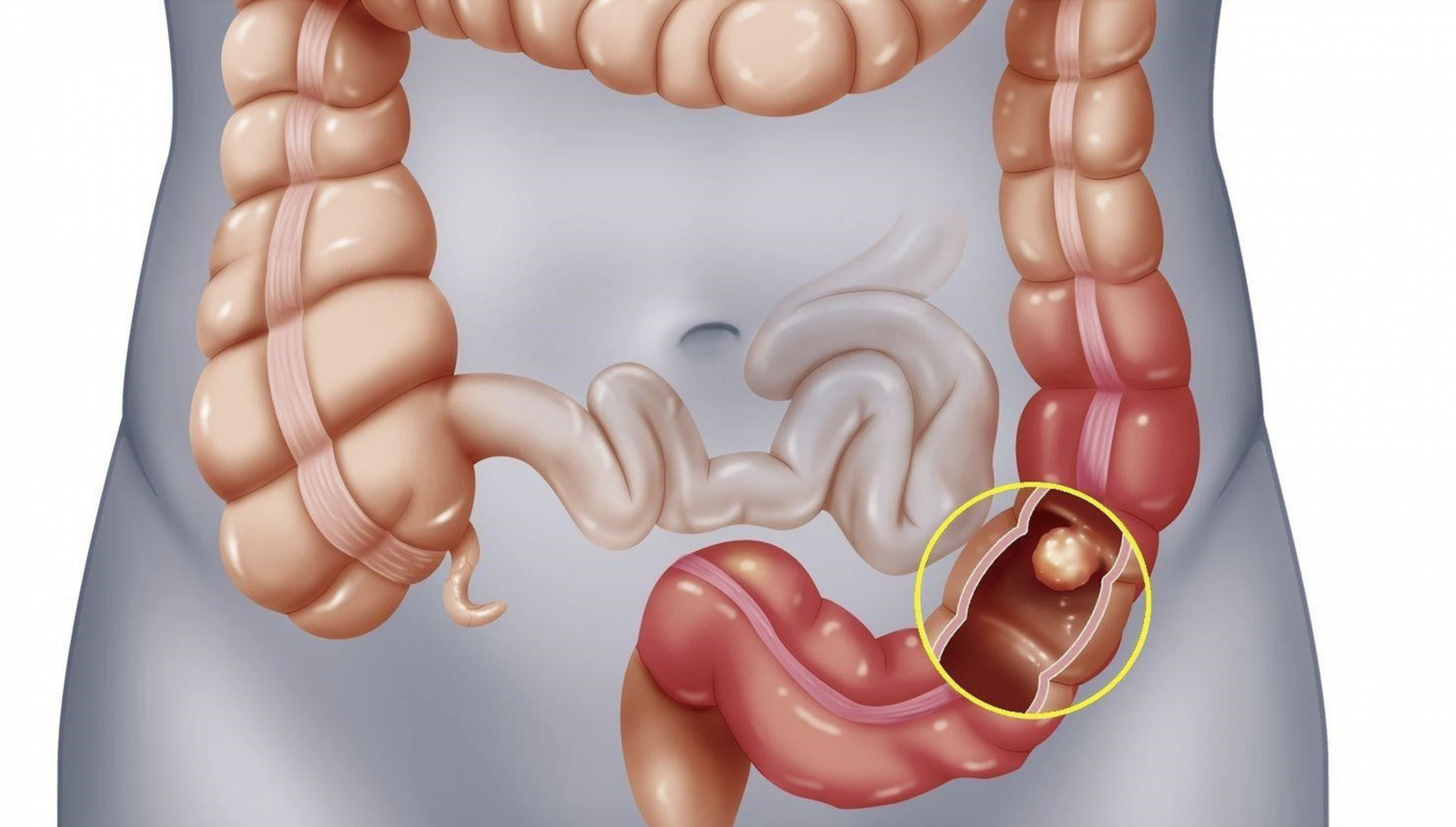Táo bón kéo dài có thể gây ung thư đại trực tràng