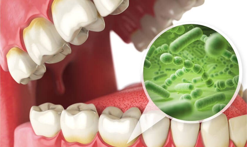 Vi khuẩn từ khoang miệng xâm nhập vào máu làm tăng viêm và nguy cơ bệnh mạch máu